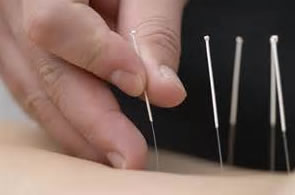 acupuncture-1