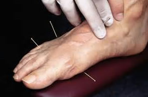 acupuncture-2